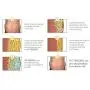 Coolsculpt IceMax Fat Freezing & Slimming Belt: Version 2.0 (New and Improved 2020) Coolsculpt IceMax Fat Freezing & Slimming Belt: Version 2.0 (New and Improved 2020)